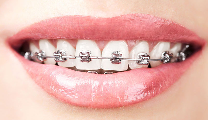 Dental braces